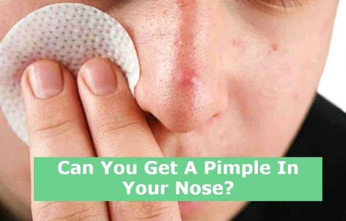 Can You Get A Pimple In Your Nose?