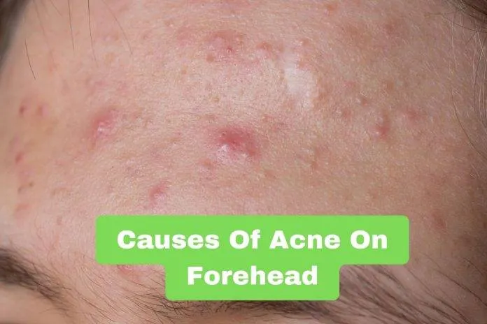 Causes Of Acne On Forehead