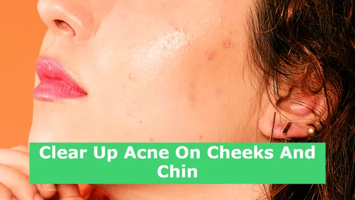 Clear Up Acne On Cheeks And Chin