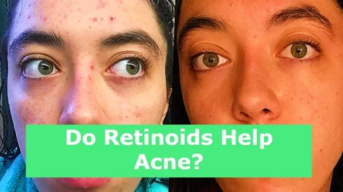Do Retinoids Help Acne?