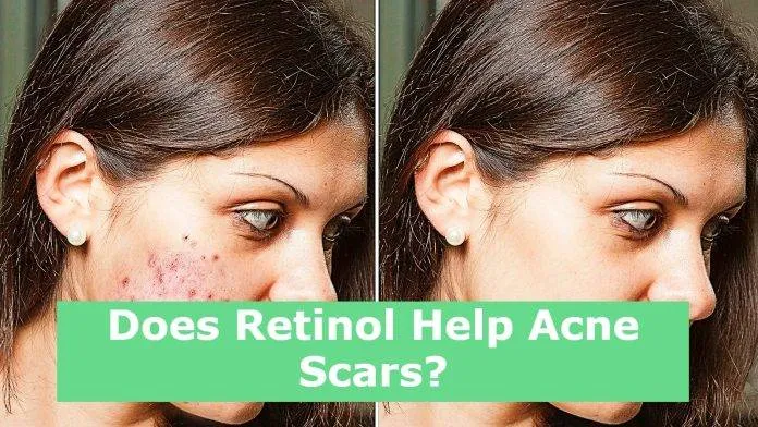 Does Retinol Help Acne Scars?