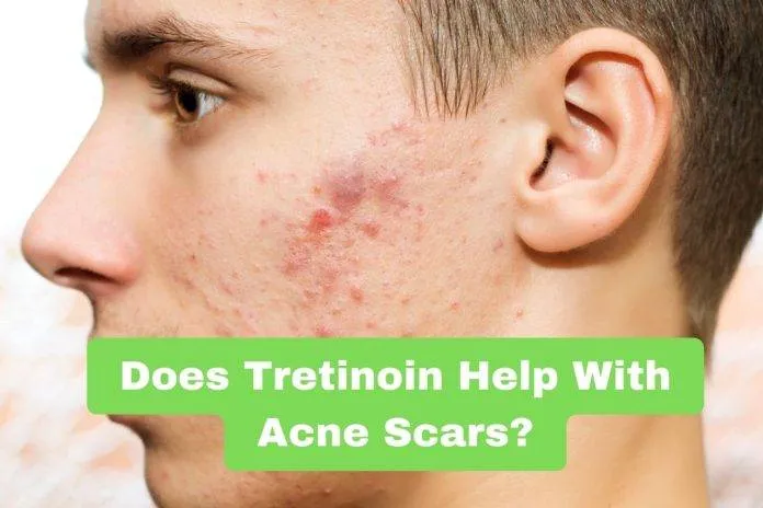 Does Tretinoin Help With Acne Scars?