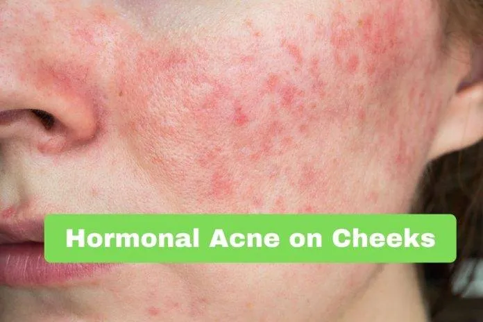 Hormonal Acne on Cheeks