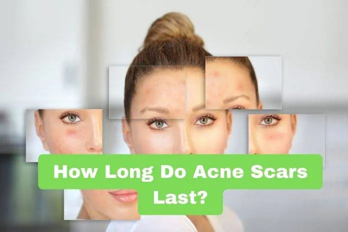 How Long Do Acne Scars Last?