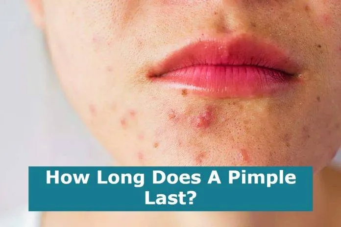 How Long Does A Pimple Last?