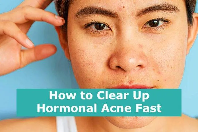 How to Clear Up Hormonal Acne Fast