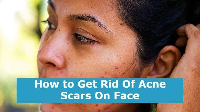How to Get Rid Of Acne Scars On Face