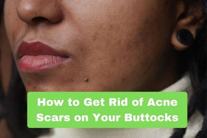 How to Get Rid of Acne Scars on Your Buttocks