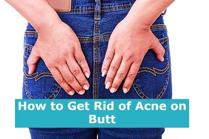How to Get Rid of Acne on Butt