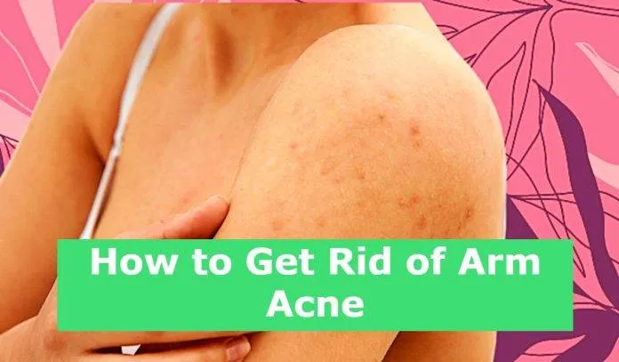How to Get Rid of Arm Acne