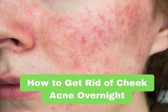 How to Get Rid of Cheek Acne Overnight