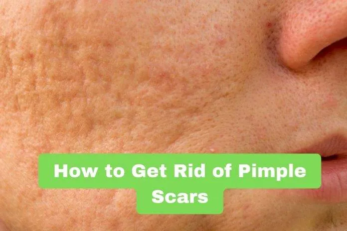 How to Get Rid of Pimple Scars