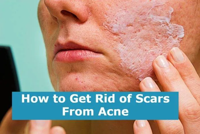 How to Get Rid of Scars From Acne