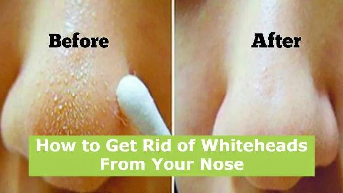How to Get Rid of Whiteheads From Your Nose