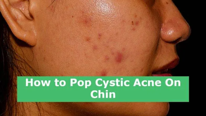 How to Pop Cystic Acne On Chin