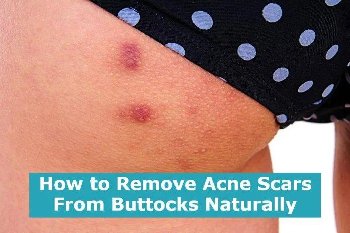 How to Remove Acne Scars From Buttocks Naturally