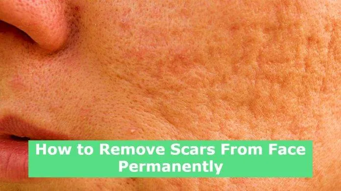How to Remove Scars From Face Permanently