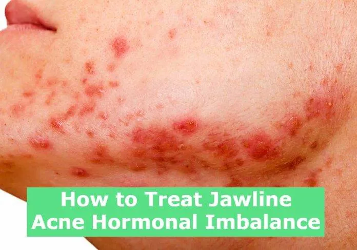 How to Treat Jawline Acne Hormonal Imbalance