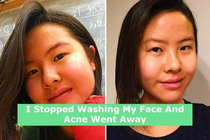I Stopped Washing My Face And Acne Went Away