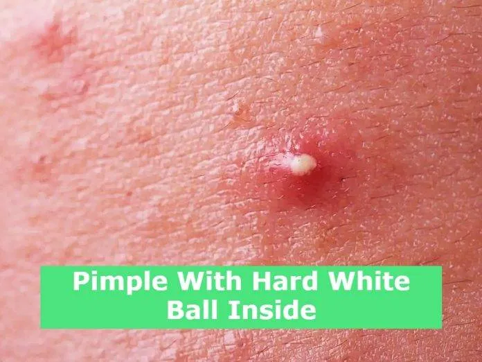 Pimple With Hard White Ball Inside