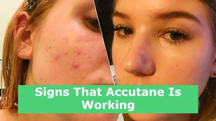 Signs That Accutane Is Working