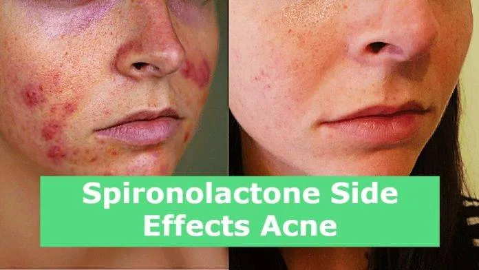 Spironolactone Side Effects Acne