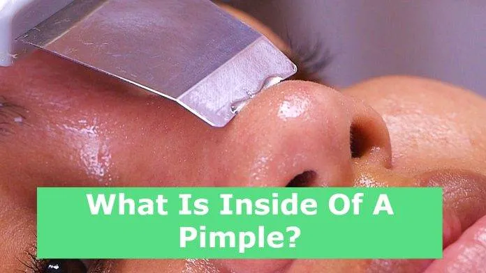 What Is Inside Of A Pimple?