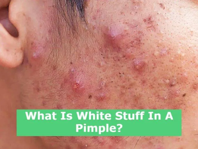 What Is White Stuff In A Pimple?