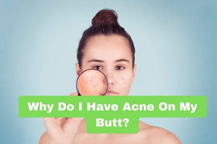 Why Do I Have Acne On My Butt?