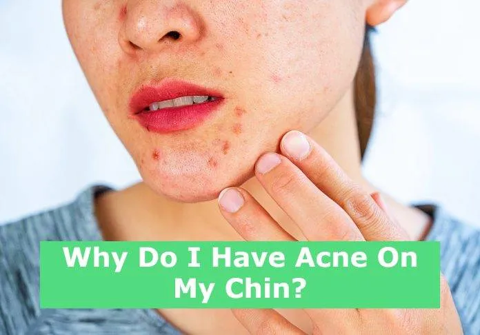 Why Do I Have Acne On My Chin?