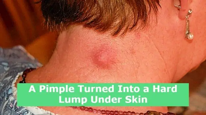 A Pimple Turned Into a Hard Lump Under Skin