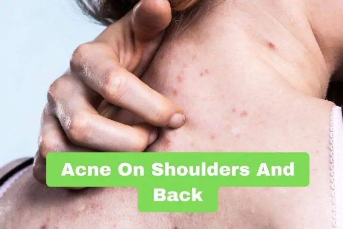 Acne On Shoulders And Back