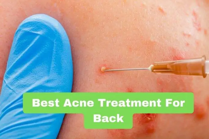 Best Acne Treatment For Back