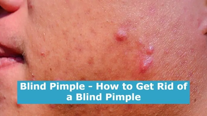 Blind Pimple - How to Get Rid of a Blind Pimple Blind Pimple - How to Get Rid of a Blind Pimple