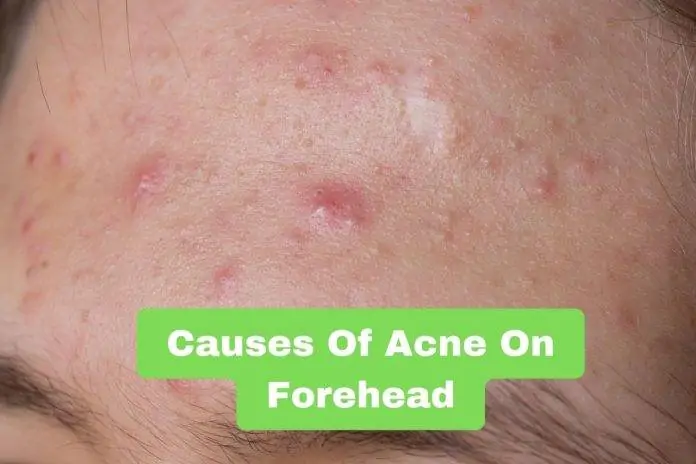 Causes Of Acne On Forehead