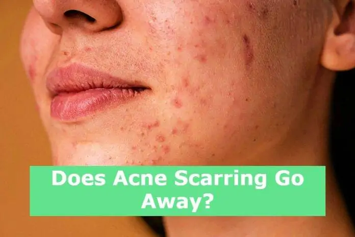 Does Acne Scarring Go Away?