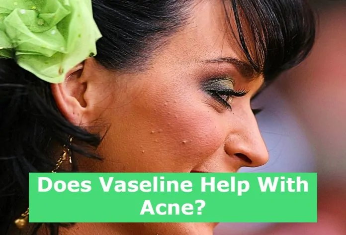 Does Vaseline Help With Acne?