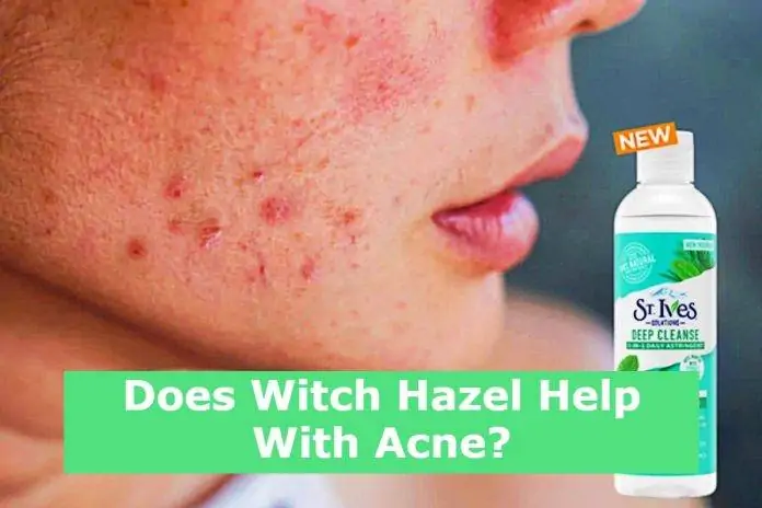 Does Witch Hazel Help With Acne?