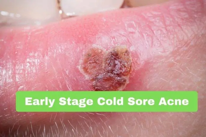 Early Stage Cold Sore Acne Early Stage Cold Sore Acne