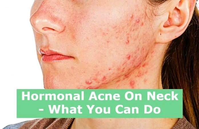 Hormonal Acne On Neck - What You Can Do