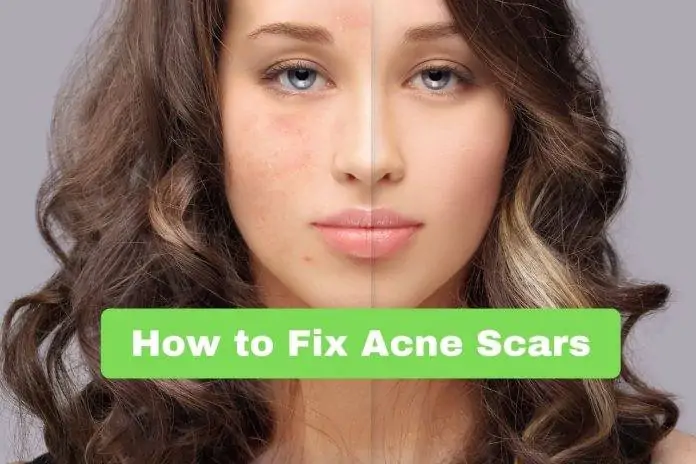 How to Fix Acne Scars