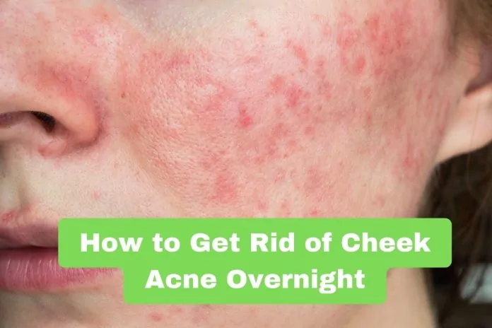 How to Get Rid of Cheek Acne Overnight