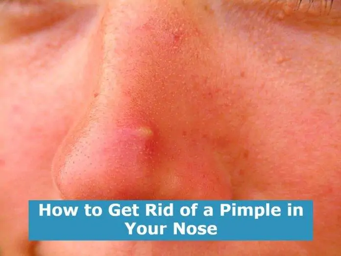 How to Get Rid of a Pimple in Your Nose How to Get Rid of a Pimple in Your Nose