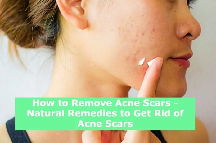 How to Remove Acne Scars - Natural Remedies to Get Rid of Acne Scars