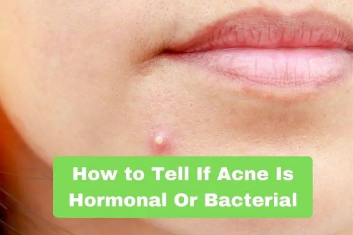 How to Tell If Acne Is Hormonal Or Bacterial