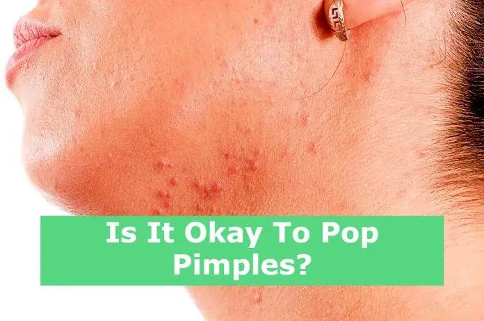 Is It Okay To Pop Pimples?