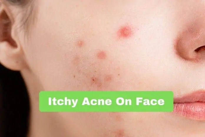 Itchy Acne On Face
