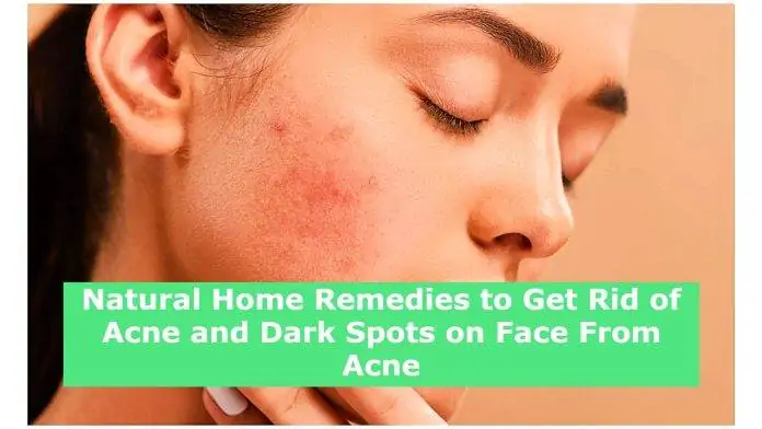 Natural Home Remedies to Get Rid of Acne and Dark Spots on Face From Acne