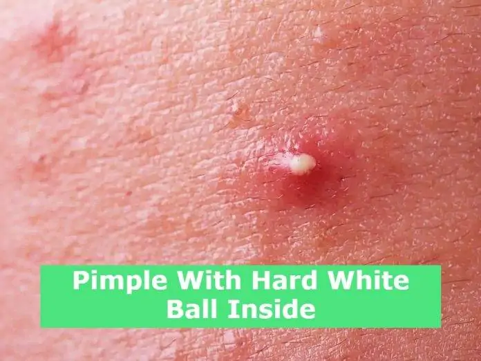 Pimple With Hard White Ball Inside