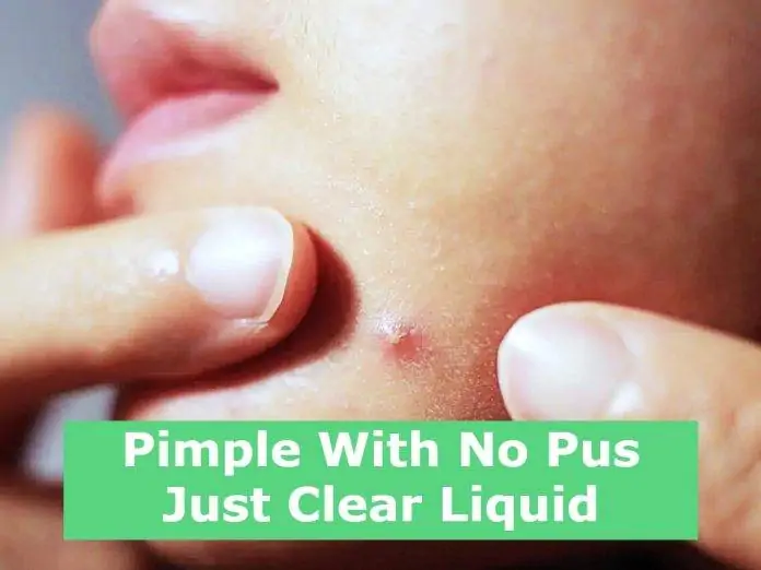 Pimple With No Pus Just Clear Liquid